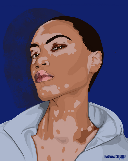 VITILIGO